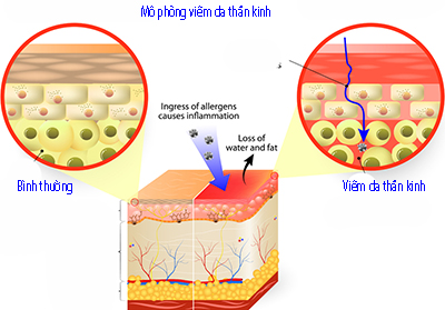 Kiến thức và cách trị liệu viêm da thần kinh