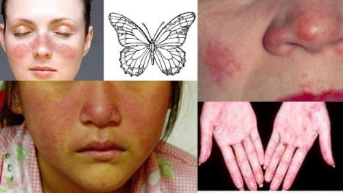 Dấu hiệu của bệnh Lupus ban đỏ