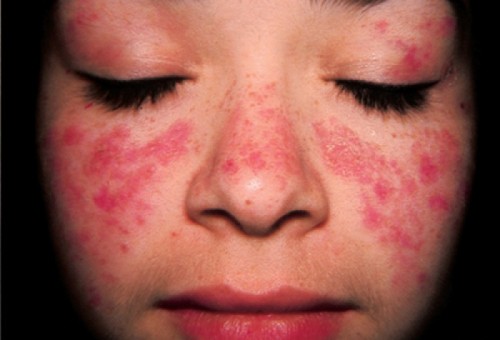 Nguyên nhân dẫn đến lupus ban đỏ