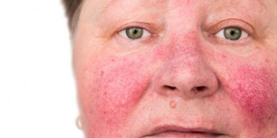 Biểu hiện thường gặp của bệnh viêm da
