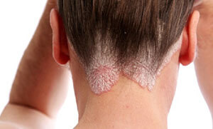 Tác hại của nấm da đầu
