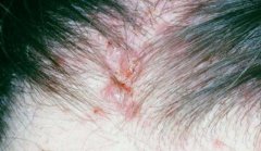 Tác hại của nấm da đầu